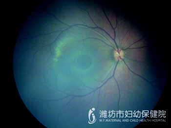 潍坊市妇幼保健院眼科专家提醒:积极眼筛,早发现