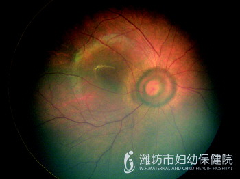 潍坊市妇幼保健院眼科专家提醒:积极眼筛,早发现