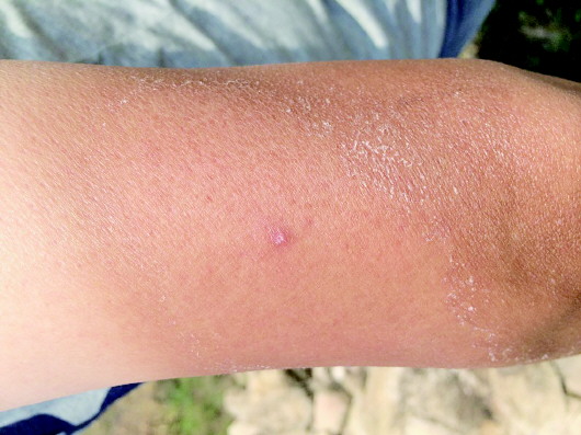 刘新征的胳膊被晒得脱皮.